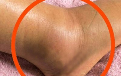 Swollen Legs: What Could It Mean? Common Causes You Should Never Ignore
