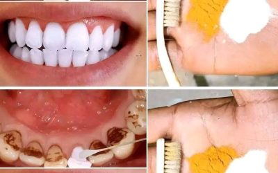 Home Teeth Whitening: Get Whiter Teeth in Just 2 Minutes