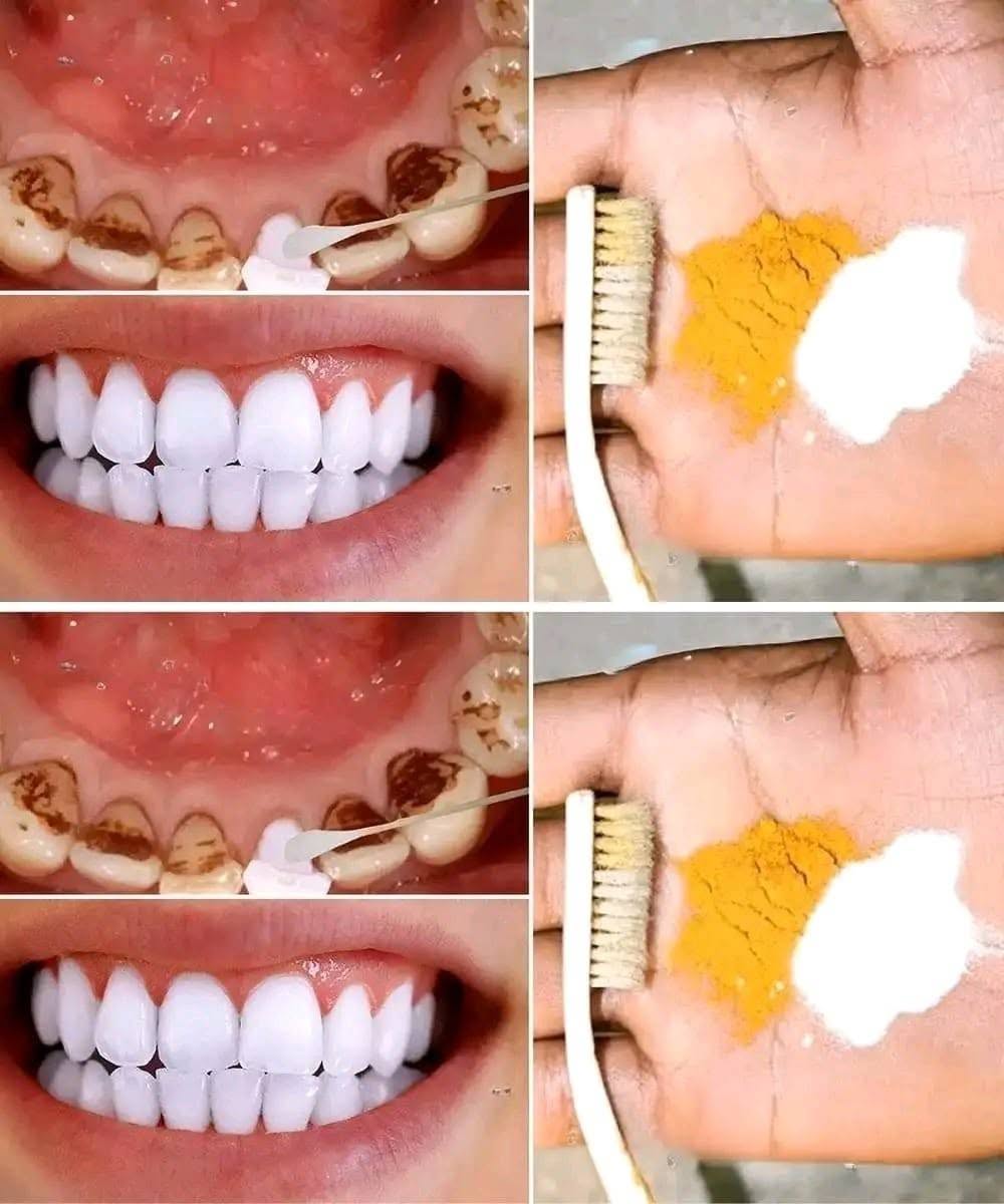 Home Teeth Whitening: Get Whiter Teeth in Just 2 Minutes