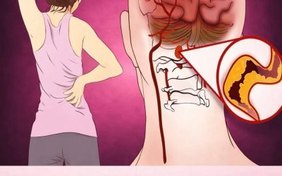 10 Early Warning Signs of a Stroke Everyone Should Know to Take Prompt Action,