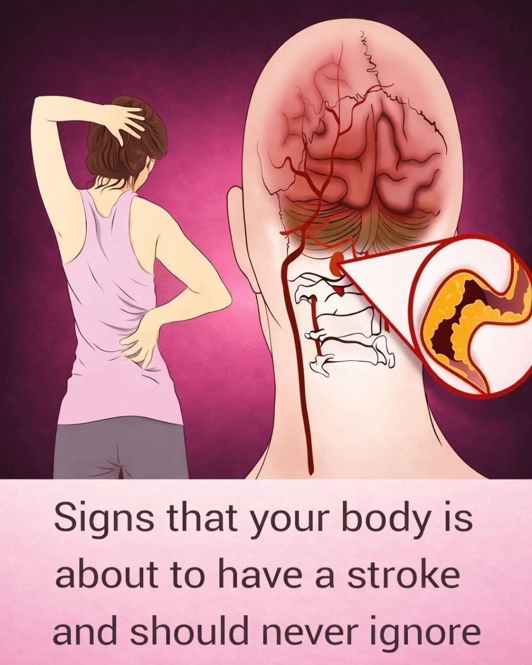 10 Early Warning Signs of a Stroke Everyone Should Know to Take Prompt Action,