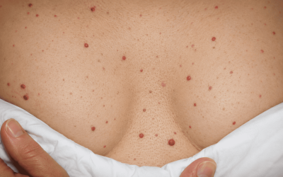 What are the red spots that appear on the skin?