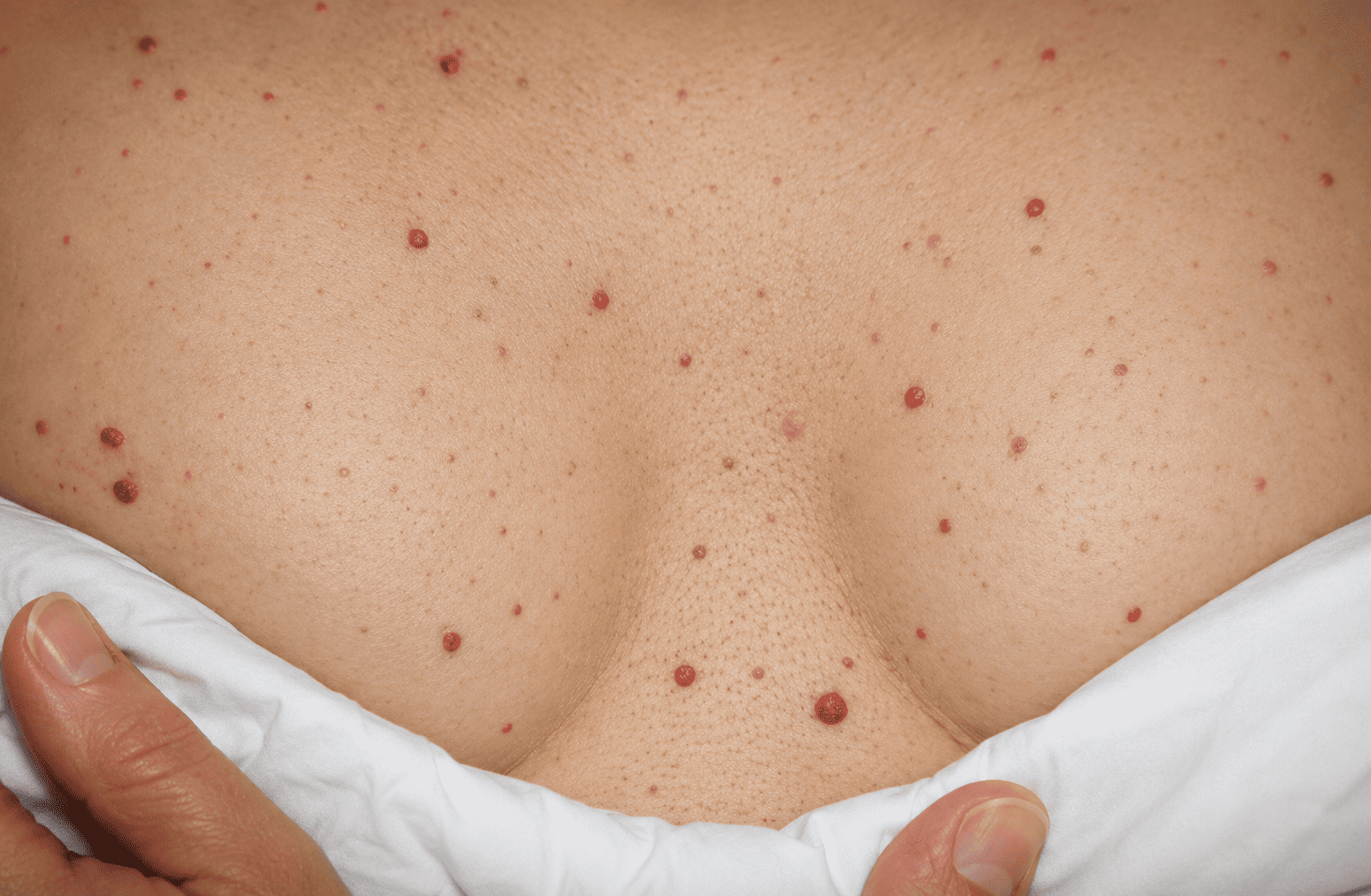 What are the red spots that appear on the skin?
