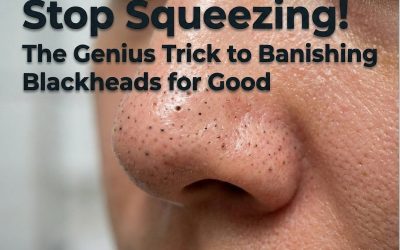 Stop Squeezing! The Genius Trick to Banishing Blackheads for Good