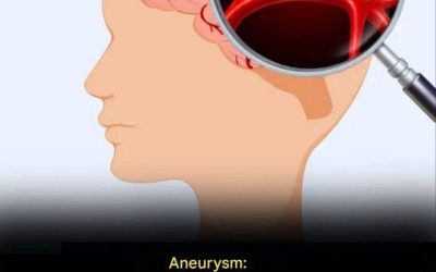 12 Symptoms That May Indicate a Brain Aneurysm – Don’t Ignore Them!