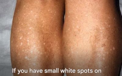 Why do I get white spots on my skin in the summer and how can I treat them? A dermatologist answers. 1