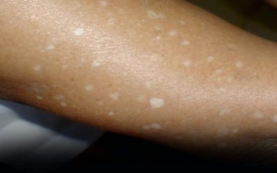Have you noticed small white spots on your arms or legs? Here’s what they are.