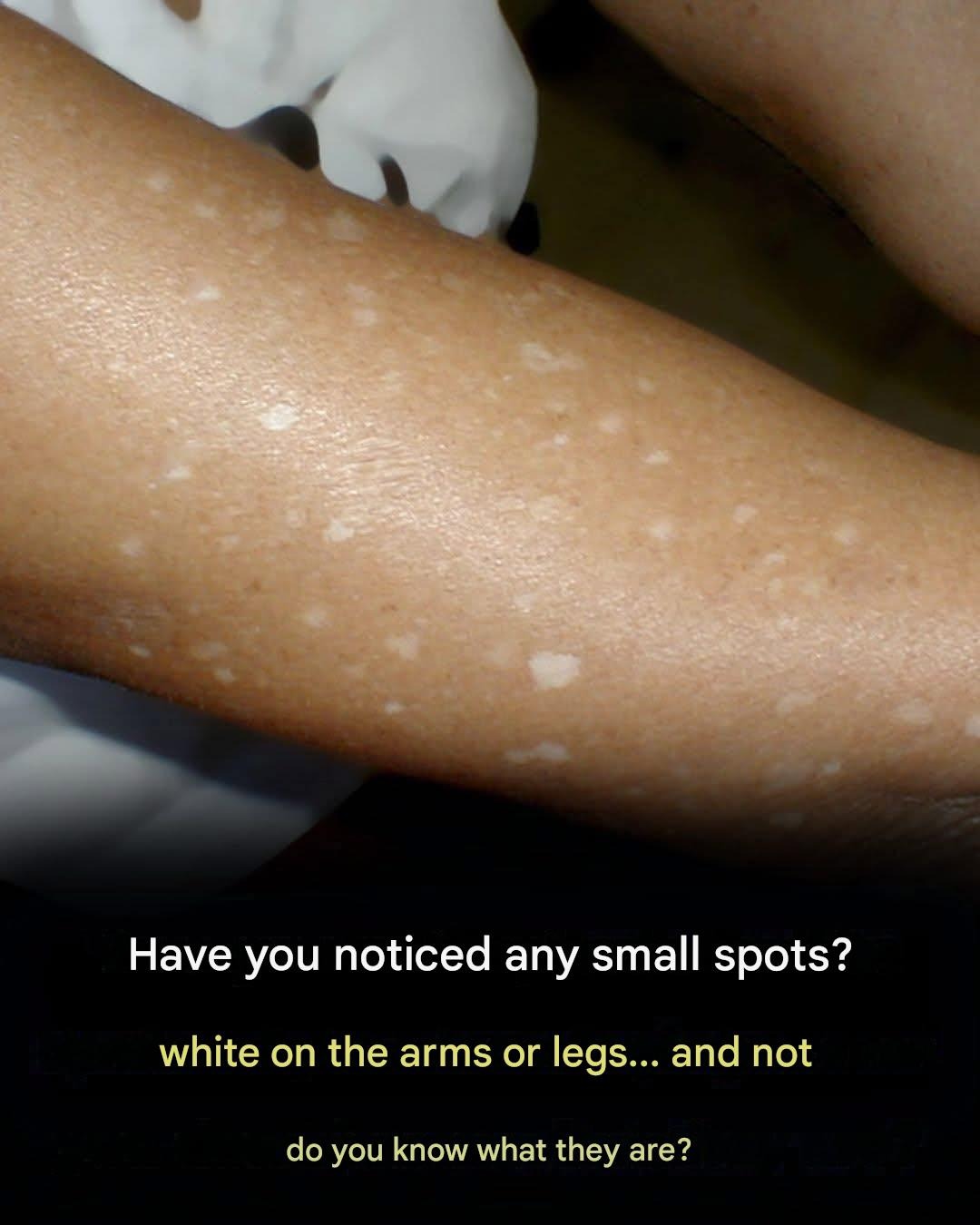 Have you noticed small white spots on your arms or legs? Here’s what they are.