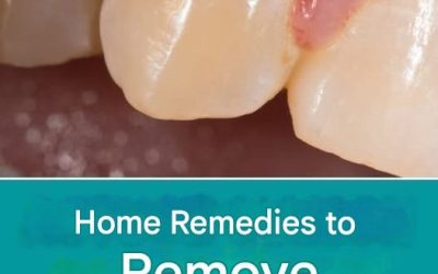 Home remedy to remove tartar yourself