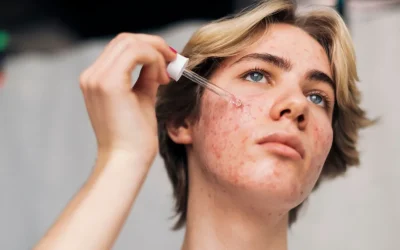 Acne: Causes, Types, and Best Treatments