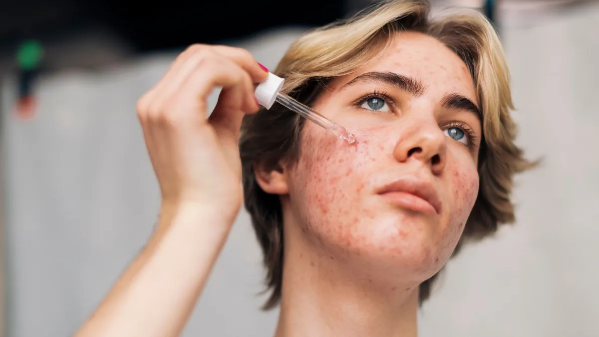 Acne: Causes, Types, and Best Treatments