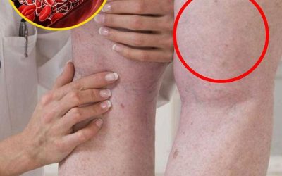 What Does a Blood Clot Feel Like? Experts Share Common Signs and Symptoms