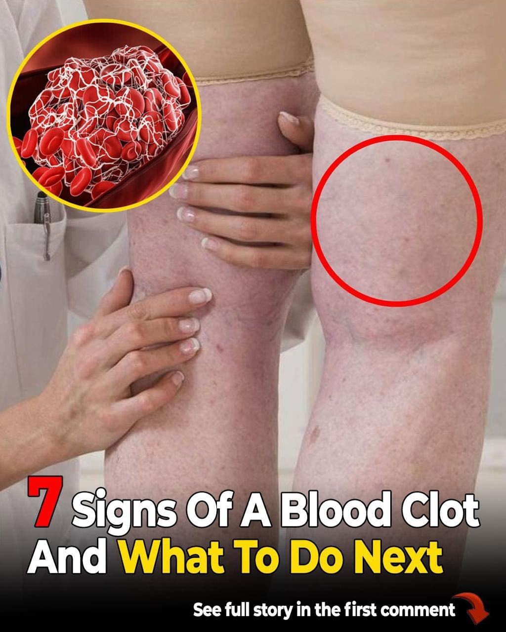 What Does a Blood Clot Feel Like? Experts Share Common Signs and Symptoms