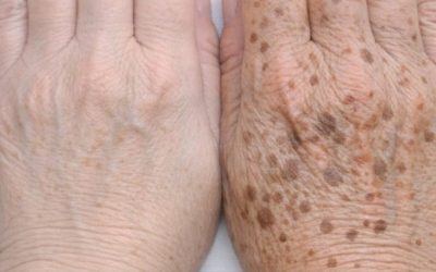 Apply this 1 solution to your hands and get rid of age spots, sun damage, and crepey skin.