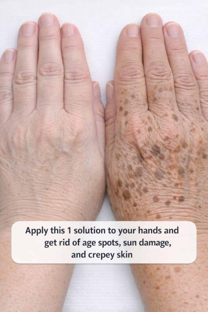 Apply this 1 solution to your hands and get rid of age spots, sun damage, and crepey skin.