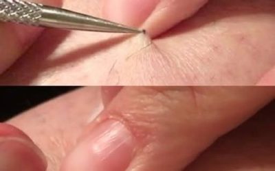 It all started with an itch, and ended in shock! A man found a black spot on his leg and started picking it off… what he removed left millions of people speechless