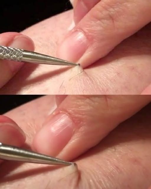 It all started with an itch, and ended in shock! A man found a black spot on his leg and started picking it off… what he removed left millions of people speechless