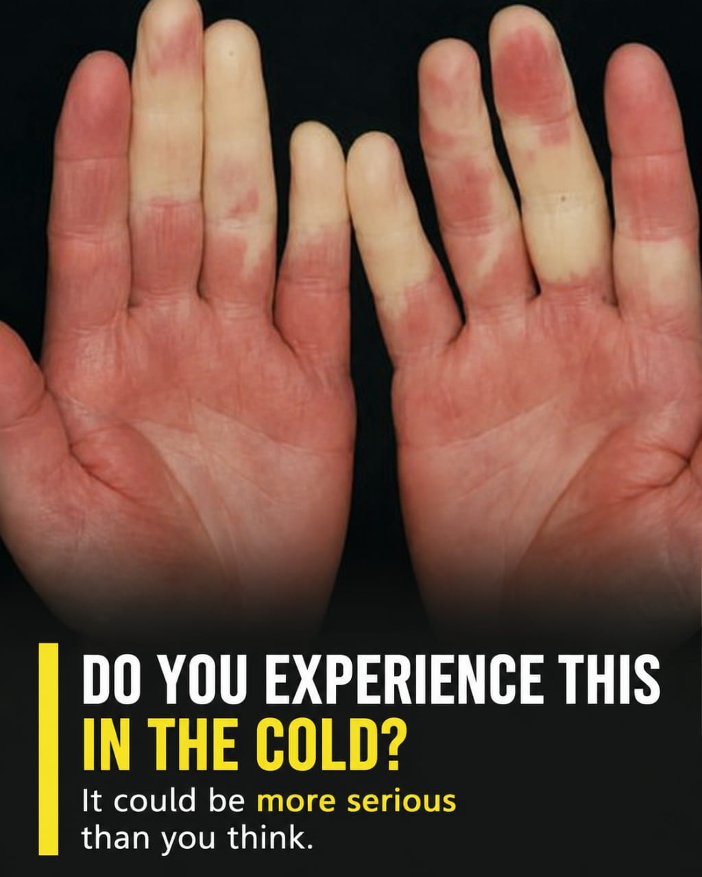 Do your fingers change color in the cold? It could be more serious than you think…..See more