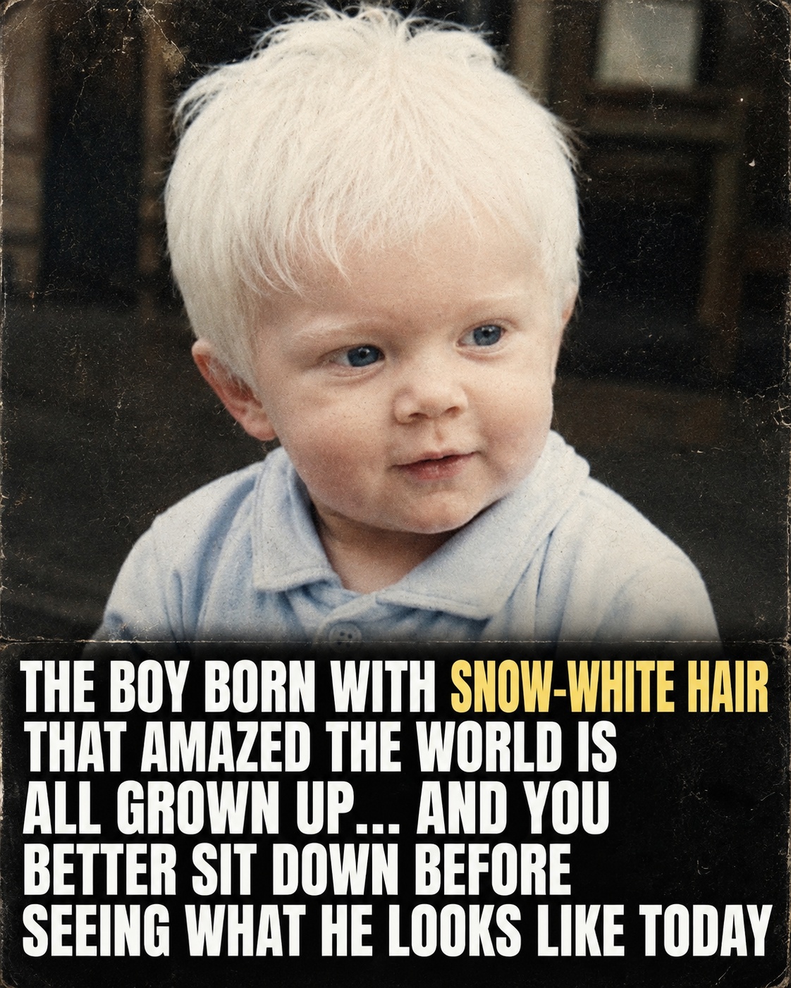 The Boy Born With Snow-White Hair – His Life Today